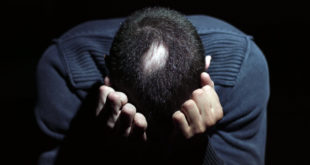 problemi di alopecia